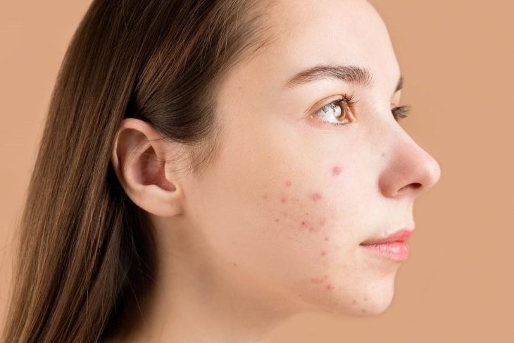 acne as symptom of polycystic ovary syndrome